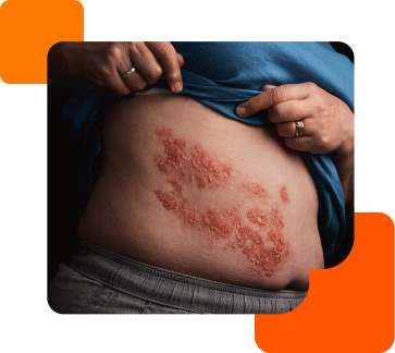 Herpes zóster